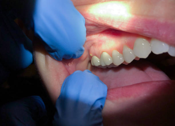 Best Emergency Wisdom Teeth Removal in Ammon, ID